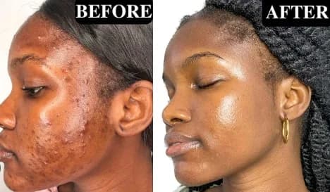 24HR SECRET client result — Within 5 weeks — my skin was CLEAR!” — Real Customer Are you battling with: Hormonal acne Blackheads Breakouts & painful spots Scars that just won’t fade Meet your new skincare BFF: THE…