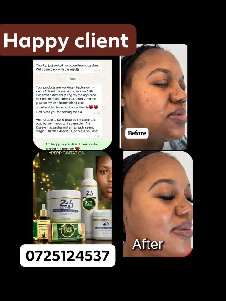 24HR SECRET client result — She struggled with mild melasma patches for 2 yrs, it was stubborn to clear even after abrasion..