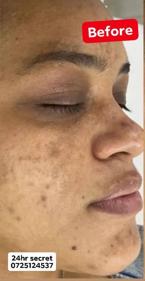 24HR SECRET client result — Another happy client From damaged skin → clear, glowing skin Step by step, real progress you can see Trust the process & stay consistent… we don’t fail