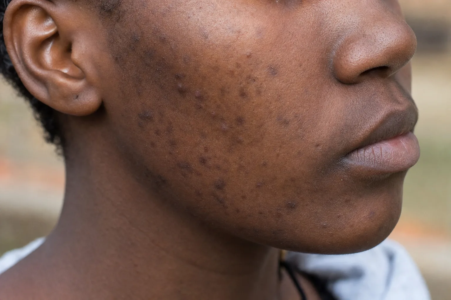 Close-up of post-acne dark spots and uneven pigmentation on the cheek of a Black African person with deep brown skin